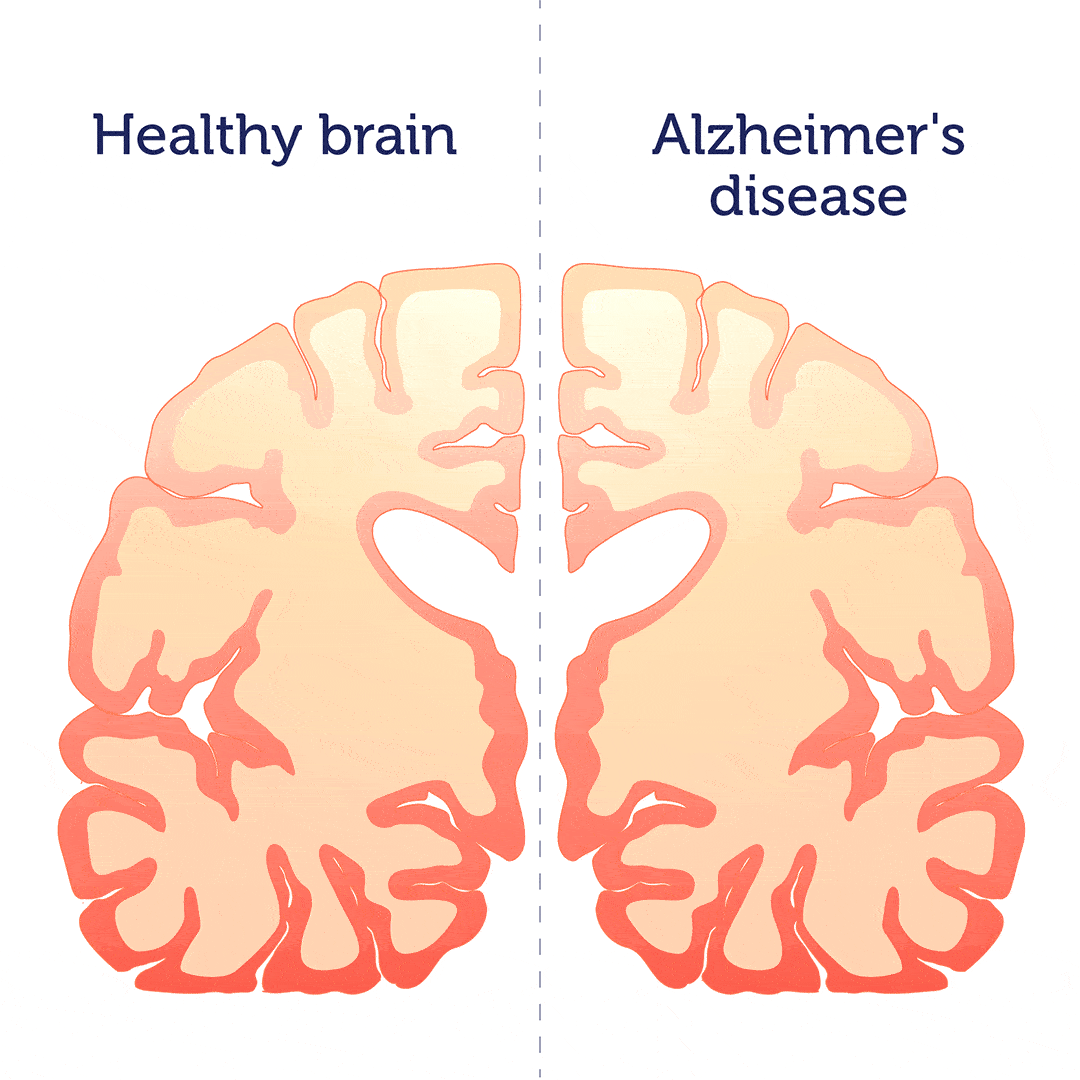 Differences in structure between a healthy brain and Alzheimer's disease brain.